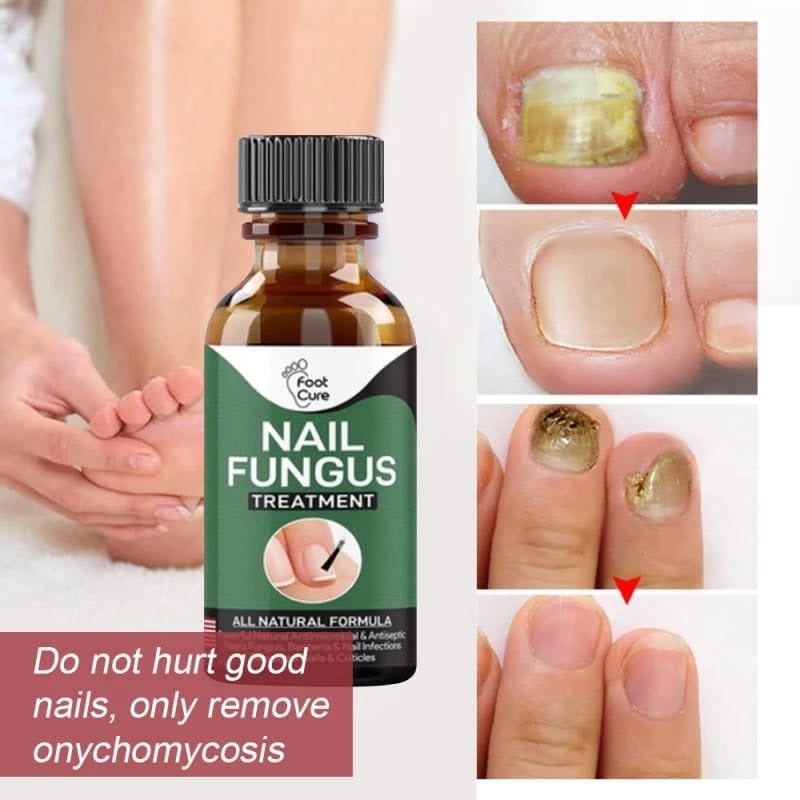 Fast Nail Fungal Treatments Essences Serum Care