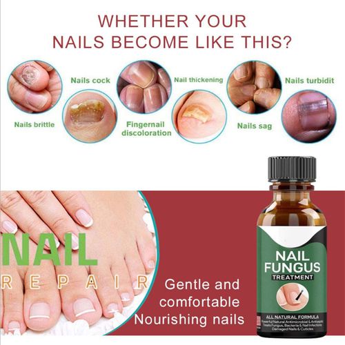 Fast Nail Fungal Treatments Essences Serum Care